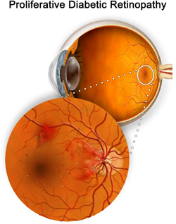 Diabetic Retinopathy Eye Exams Baltimore Washington Eye Center