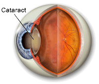 cataract lens implants baltimore eye surgery laser washington center care